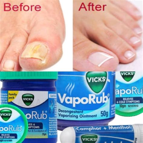 2) Use a clean towel to dry the feet. . Vicks vaporub for ingrown toenails